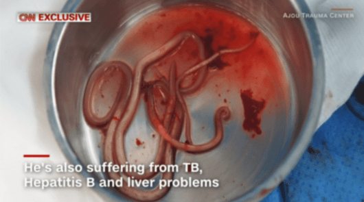 亡命した北朝鮮兵士の体内から取り出された寄生虫(CNN)